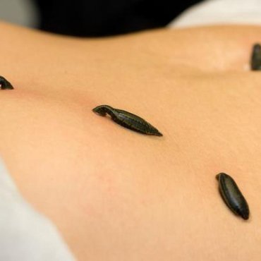 Гирудотерапия